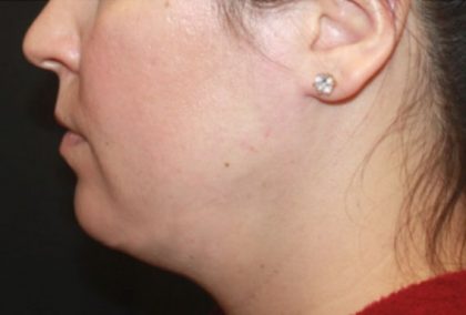 Kybella Before & After Patient #25350