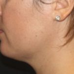 Kybella Before & After Patient #25350