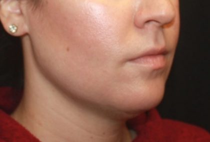 Kybella Before & After Patient #25350