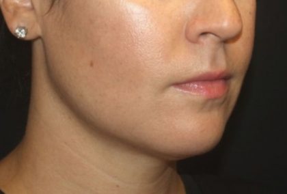 Kybella Before & After Patient #25350