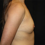 Breast Augmentation - Round Silicone Implants Before & After Patient #25506
