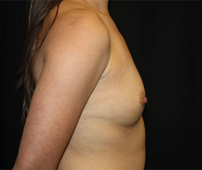 Breast Augmentation - Round Silicone Implants Before & After Patient #25506