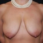 Breast Lift with Implant Before & After Patient #26838