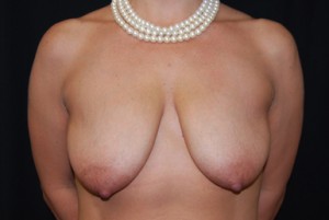 Breast Lift with Implant Before & After Patient #26838