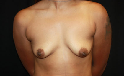 Breast Lift with Implant Before & After Patient #26728