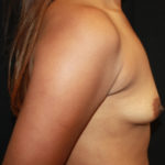 Breast Lift with Implant Before & After Patient #26728