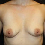 Breast Lift with Implant Before & After Patient #27015
