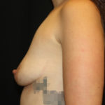 Breast Lift with Implant Before & After Patient #27015