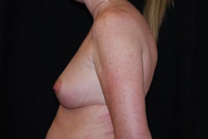 Breast Augmentation - Round Silicone Implants Before & After Patient #26002