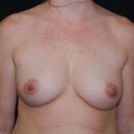 Breast Augmentation - Round Silicone Implants Before & After Patient #26002