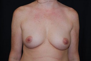 Breast Augmentation - Round Silicone Implants Before & After Patient #26002