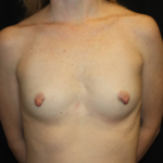 Breast Augmentation - Shaped Silicone Implants Before & After Patient #26373