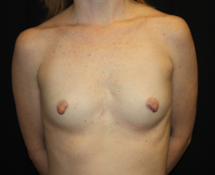 Breast Augmentation - Shaped Silicone Implants Before & After Patient #26373