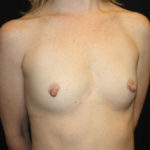 Breast Augmentation - Shaped Silicone Implants Before & After Patient #26373