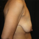 Breast Lift with Implant Before & After Patient #26735