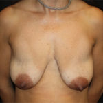 Breast Lift with Implant Before & After Patient #26735