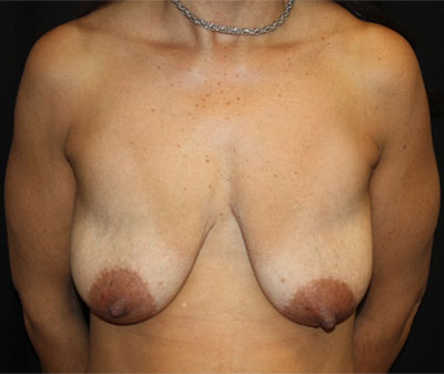 Breast Lift with Implant Before & After Patient #26735