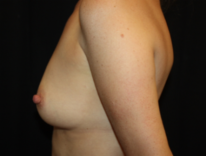 Breast Augmentation - Round Silicone Implants Before & After Patient #26013