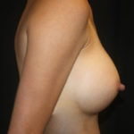 Breast Augmentation - Round Silicone Implants Before & After Patient #25726