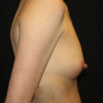 Breast Augmentation - Round Silicone Implants Before & After Patient #25726