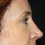 Blepharoplasty and Brow Lift Before & After Patient #25411