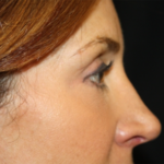 Blepharoplasty and Brow Lift Before & After Patient #25411