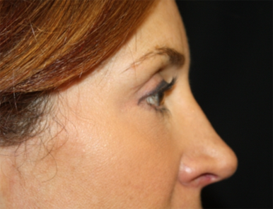 Blepharoplasty and Brow Lift Before & After Patient #25411