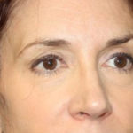 Blepharoplasty and Brow Lift Before & After Patient #25411