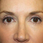 Blepharoplasty and Brow Lift Before & After Patient #25411