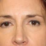 Blepharoplasty and Brow Lift Before & After Patient #25411