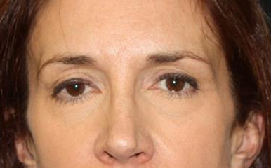 Blepharoplasty and Brow Lift Before & After Patient #25411