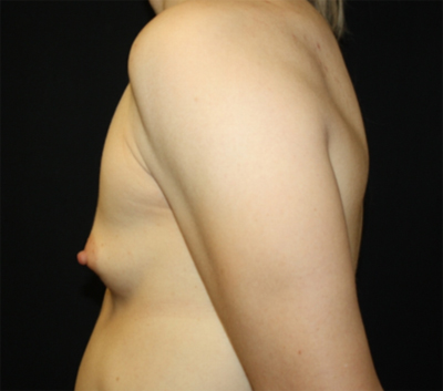 Breast Augmentation - Shaped Silicone Implants Before & After Patient #26406