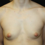 Breast Augmentation - Shaped Silicone Implants Before & After Patient #26406