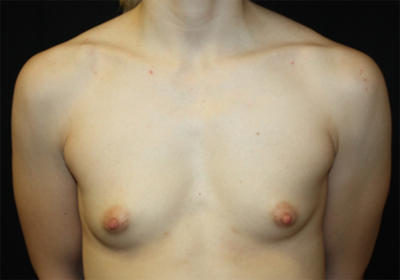 Breast Augmentation - Shaped Silicone Implants Before & After Patient #26406