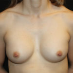 Breast Augmentation - Shaped Silicone Implants Before & After Patient #26406