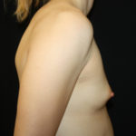 Breast Augmentation - Shaped Silicone Implants Before & After Patient #26406