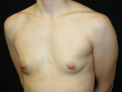 Breast Augmentation - Shaped Silicone Implants Before & After Patient #26406