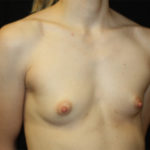 Breast Augmentation - Shaped Silicone Implants Before & After Patient #26406