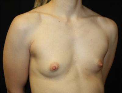 Breast Augmentation - Shaped Silicone Implants Before & After Patient #26406