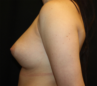 Breast Implant Exchange Before & After Patient #26667