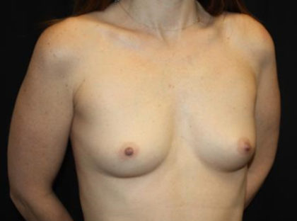Breast Augmentation - Round Silicone Implants Before & After Patient #25704