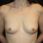 Breast Augmentation - Round Silicone Implants Before & After Patient #25704