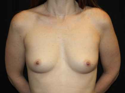 Breast Augmentation - Round Silicone Implants Before & After Patient #25704