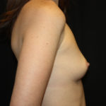 Breast Augmentation - Round Silicone Implants Before & After Patient #25704