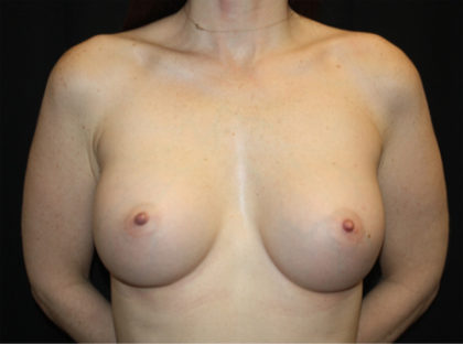 Breast Augmentation - Round Silicone Implants Before & After Patient #25704