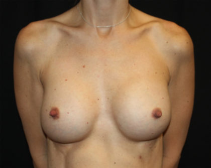 Breast Augmentation - Shaped Silicone Implants Before & After Patient #26417