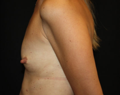 Breast Augmentation - Shaped Silicone Implants Before & After Patient #26417