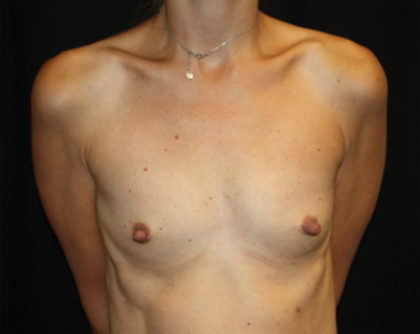 Breast Augmentation - Shaped Silicone Implants Before & After Patient #26417