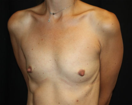 Breast Augmentation - Shaped Silicone Implants Before & After Patient #26417