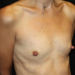 Breast Augmentation - Shaped Silicone Implants Before & After Patient #26417